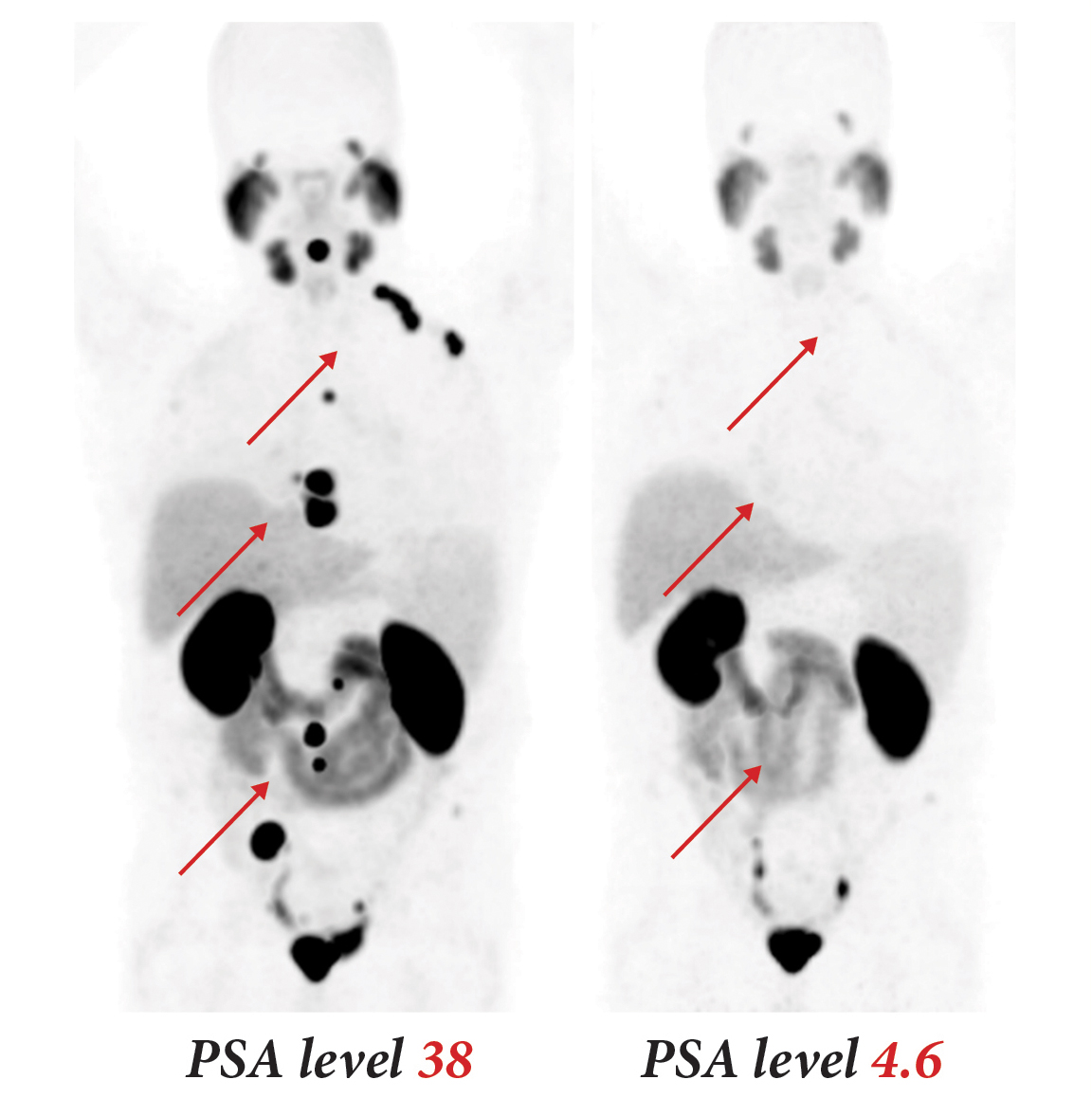 Pmsa Radiology Award-winning agent developed for prostate cancer diagnosis and ...
